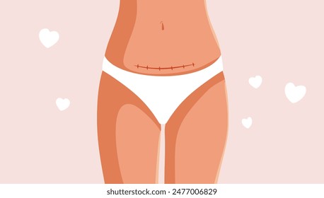 
Woman Proudly Showing Her C Section Vector Cartoon Illustration. Postpartum body of a new mom with love scar 
