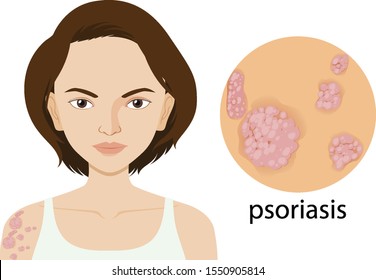 Woman With Psoriasis On Poster Illustration