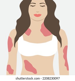 Woman with Psoriasis Red Skin Illness Illustration Design