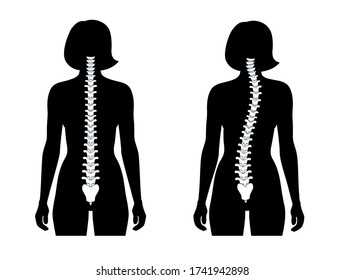 Woman scoliosis flat vector illustration. Types of scoliosis of spine infographics. Diagram with spine curvatures and healthy backbone. Body posture defect. Medical, educational and science banner