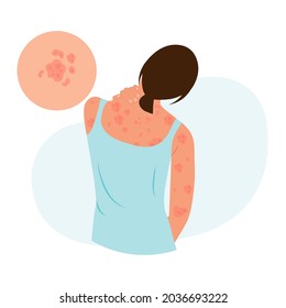 The woman is scratching her back. Allergic itching, skin inflammation, redness and irritation.Guttate psoriasis.Atopic dermatitis, eczema, psoriasis, dry skin. Skin problems.isolated, vector.