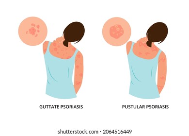 The woman is scratching her back. Allergic itching, skin inflammation, redness and irritation.Guttate,postular psoriasis.Atopic dermatitis, eczema, psoriasis, dry skin. Skin problems.isolated, vector.