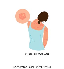 The Woman Is Scratching Her Back. Allergic Itching, Skin Inflammation, Redness And Irritation.Postular Psoriasis.Atopic Dermatitis, Eczema, Psoriasis, Dry Skin. Skin Problems.isolated, Vector.