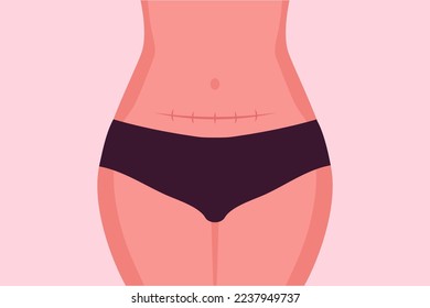 Woman Showing Belly with Stitches from Cesarean Section Surgery operation with Vertical scar