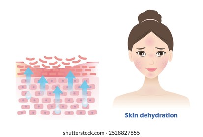 The woman with skin dehydration vector illustration. Cross section of dry skin barrier layer lead to more water leaving skin and lacks water in the uppermost layer. Skin care and beauty concept.