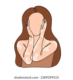 A woman with skin pigmentation disorder. Light spots on the skin. Vitiligo. World Vitiligo Day. One line drawing for different uses. Color vector illustration.