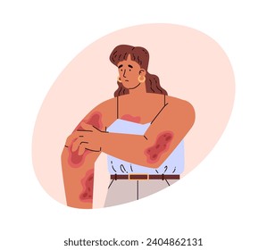 Mujer con problemas de piel y enfermedades. Ilustración vectorial en estilo plano de caricatura, aislada en fondo blanco. Paciente mujer con psoriasis. Triste enferma con reacción alérgica en su cuerpo.