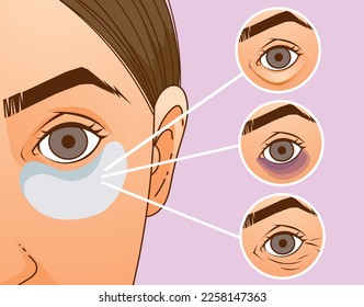 The woman with the skin problems. Wrinkles, dark circles. Under-eyes area. Under-eyes patches. Skin care, cosmetology procedure. Healthcare Illustration. Vector illustration.