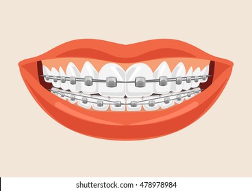 Woman Smile With Braces. Vector Flat Cartoon Illustration