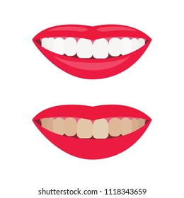 Woman smile. Comparison of smile with dirty and whitened teeth. Before and after view
