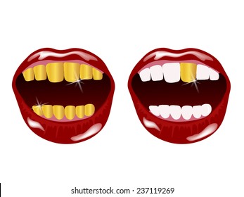 Woman smile with golden teeth