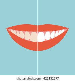 Woman smile. Teeth whitening. Dental care. Before and after view of teeth whitening