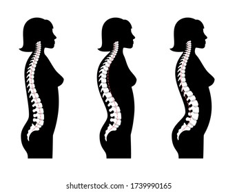 Woman spinal deformity flat vector illustration. Kyphosis, lordosis of spine. Diagram with spine curvatures and healthy backbone. Body posture defect. Medical, educational and science banner