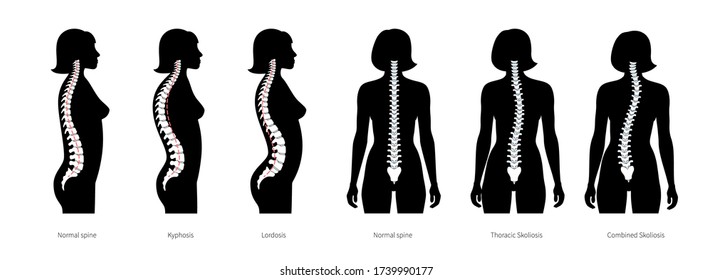 Woman spinal deformity flat vector illustration. Kyphosis, lordosis and scoliosis of spine infographics.. Body posture defect. Medical, educational and science banner.