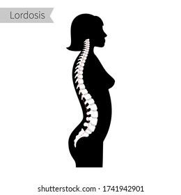 Woman spinal deformity flat vector illustration. Lordosis of spine. Diagram with spine curvatures and healthy backbone. Body posture defect. Medical, educational and science banner