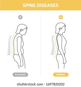 Woman standing in good and bad posture. Correct and incorrect pose. Scoliosis, Spine disease, Back body defect. Side view. Infographic, Icon, Flat design style. Isolated line vector illustration.