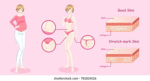 woman with stretch mark skin on the pink background