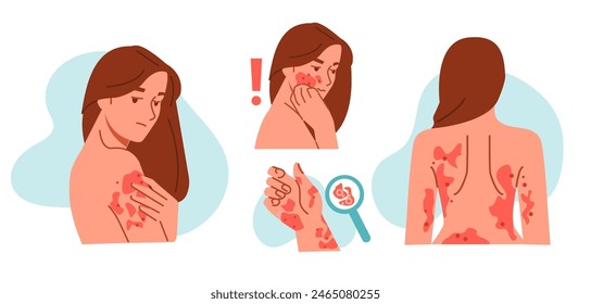 Woman suffer from rash eczema or atopic dermatitis and scratch her irritated face, hand and body skin. Allergic reaction with itching concept. Vector illustration.