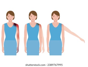 A woman suffering from shoulder pain due to frozen shoulder and periarthritis. Acute phase, chronic phase, recovery phase.