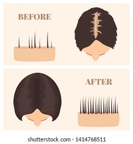 Woman with thinning hair before and after hair regrowth. Female pattern baldness set with skin cross-section diagram. Treatment result in top view. Alopecia infographics medical vector template.