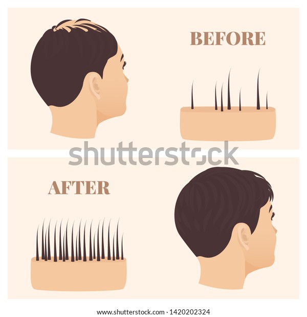 Woman Thinning Hair Before After Hair Stock Image Download Now