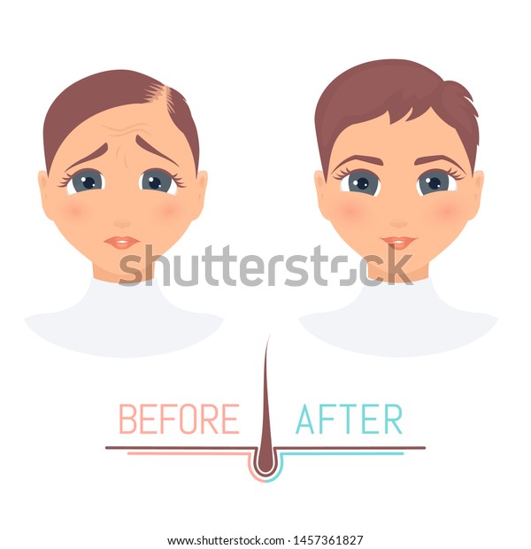 Woman Thinning Hair Before After Hair Stock Vector Royalty Free