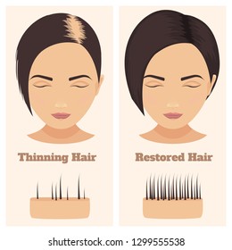 Woman with thinning and restored hair. Female pattern alopecia set with skin cross-section diagram. Before and after concept. Vector illustration. 