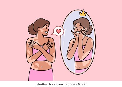 Woman with vitiligo syndrome or spots on skin looks in mirror and smiles, accepting herself as she is. Ethnic girl with high self-esteem and vitiligo disease feels sympathy for own reflection