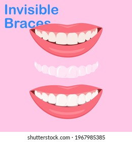 Woman wearing orthodontic silicone trainer. Invisible braces aligner. invisalign braces or invisible retainer. beautiful smile.