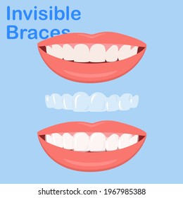 Woman wearing orthodontic silicone trainer. Invisible braces aligner. invisalign braces or invisible retainer. beautiful smile.