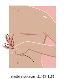 A woman who survived cancer. Mastectomy. Mastectomy scar. breast cancer. svg