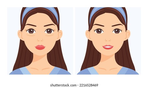 Woman with Wrinkles Around her Eyes. Wrinkle Treatment. Blephoroplasty. Before After. Young Skin and a Happy Lady. Color Cartoon style. White background. Vector illustration for Beauty Cosmetic Design