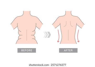 Woman's back before and after weight loss.. Back fat compared to slim back.