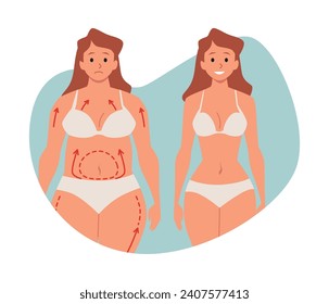 El cuerpo de la mujer antes y después de la cirugía plástica estilo plano, ilustración vectorial aislada en fondo blanco. Elemento de diseño decorativo, salud y belleza, personajes disgustados y felices