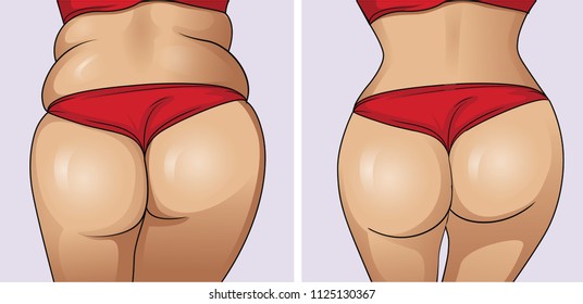 Woman's body before and after weight loss.