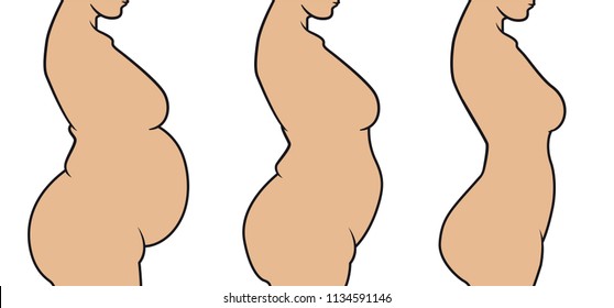 Woman's body before and after weight loss.