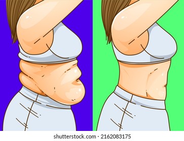 A woman's body with belly fat. Before, after. Healthcare illustration. Vector illustration.