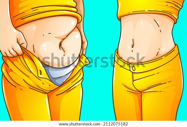 A woman\'s body with\
belly fat. Before, after. Healthcare illustration. Vector\
illustration. 