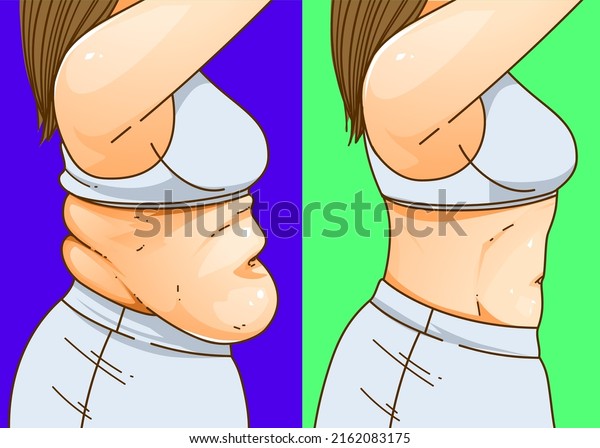 Womans Body Belly Fat Before After Stock Vector Royalty Free