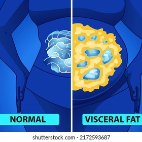 A woman's body with belly fat. Problem zone. Medical infographic. Healthcare illustration. Vector illustration. 