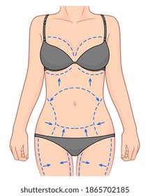 El cuerpo de la mujer con líneas punteadas para cirugía plástica y liposucción. Ilustración vectorial. 