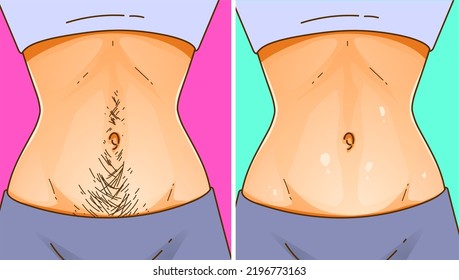 A woman's body with health problems. Hirsutism. Before, after. Medical illustration. Vector illustration.