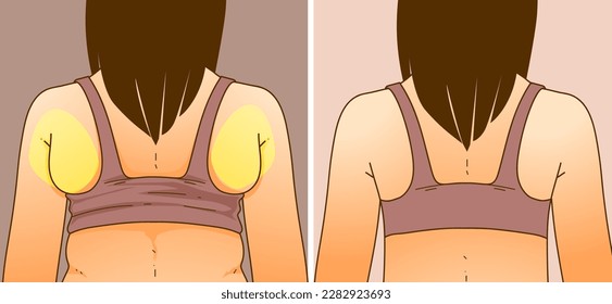A woman's body with problem areas. Back fat. Bra bulge. Before, after. Medical infographic. Healthcare illustration. Vector illustration. svg