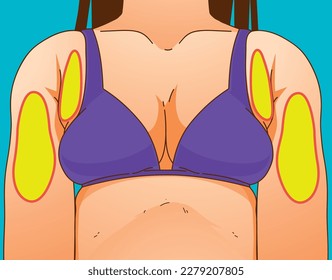 A woman's body with problem areas. Bra bulge. Medical infographic. Healthcare illustration. Vector illustration. 