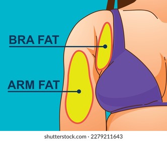 A woman's body with problem areas. Bra bulge. Medical infographic. Healthcare illustration. Vector illustration. 