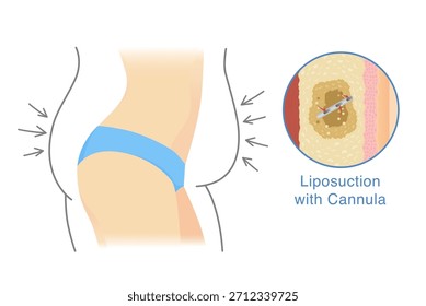 Cuerpo de mujer con una figura bien formada, con líneas de una mujer gorda y flechas alrededor en el exterior. Se está succionando más grasa subcutánea con la cánula. Transformación corporal por liposucción.