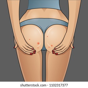 Woman's buttocks with problematic skin. 