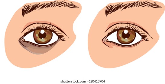 The Woman's Face With Dark Circles Under The Eyes. The Concept Of Care For Eye Skin. Before And After