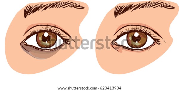 The woman\'s face with dark\
circles under the eyes. The concept of care for eye skin. before\
and after