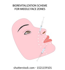 Woman's face demonstrating biorevitalization scheme for upper and middle face
